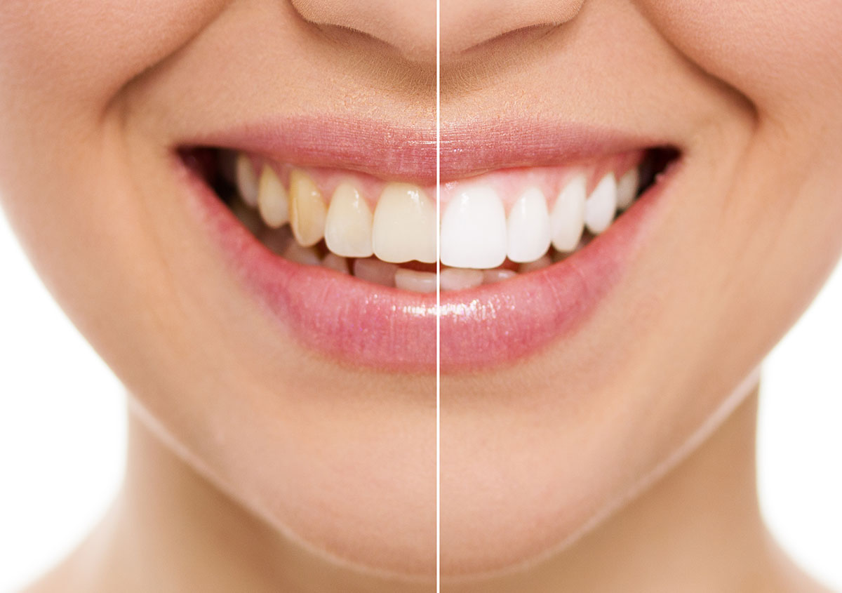 A woman before and after teeth whitening