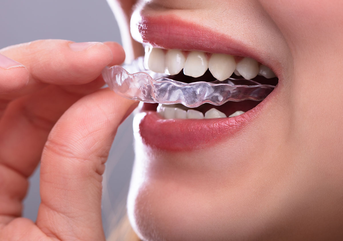 A woman is using invisalign