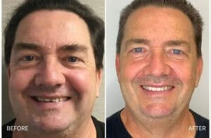 Before after images for Combination of Invisalign, Implants, and Bridges in Manakin-sabot VA Area