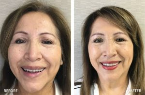 Before after images for Smile Makeover – Dental Implants and Veneers