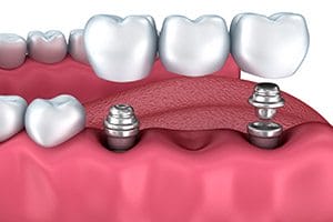 Dental Implants