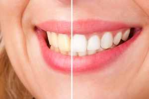 Teeth whitening before after