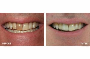 Before after images for Whitening and Crown