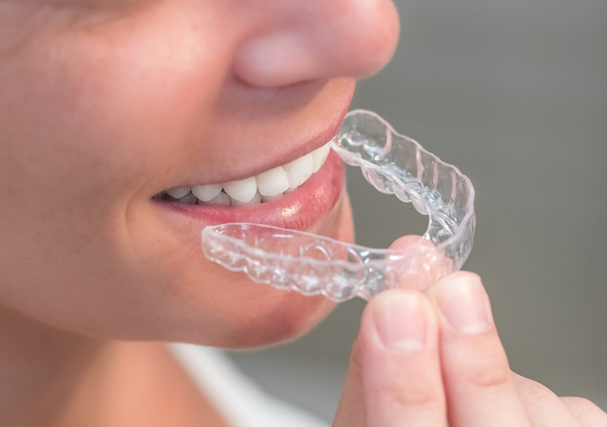 Clear Teeth Aligners in Manakin-Sabot VA Area