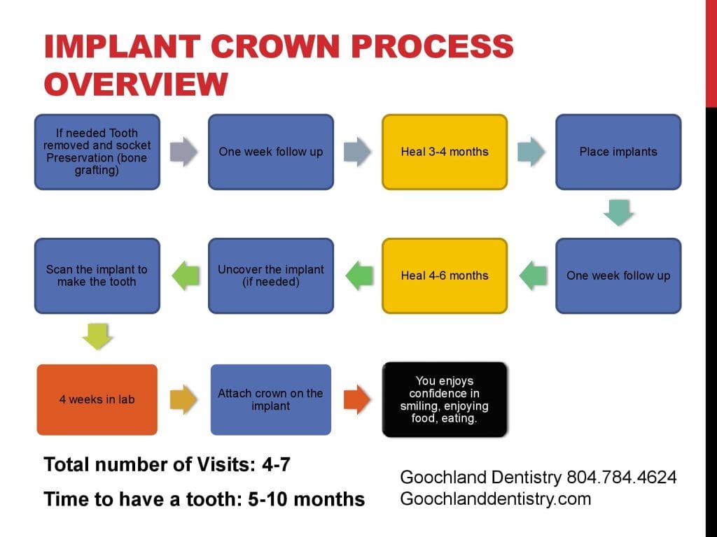 Implant Steps and Process for patients 001