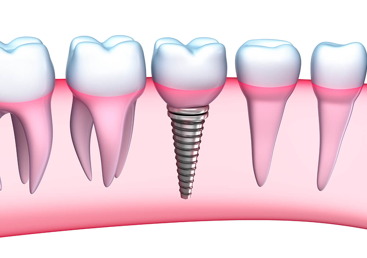 Missing Teeth Implants in Manakin-sabot VA Area
