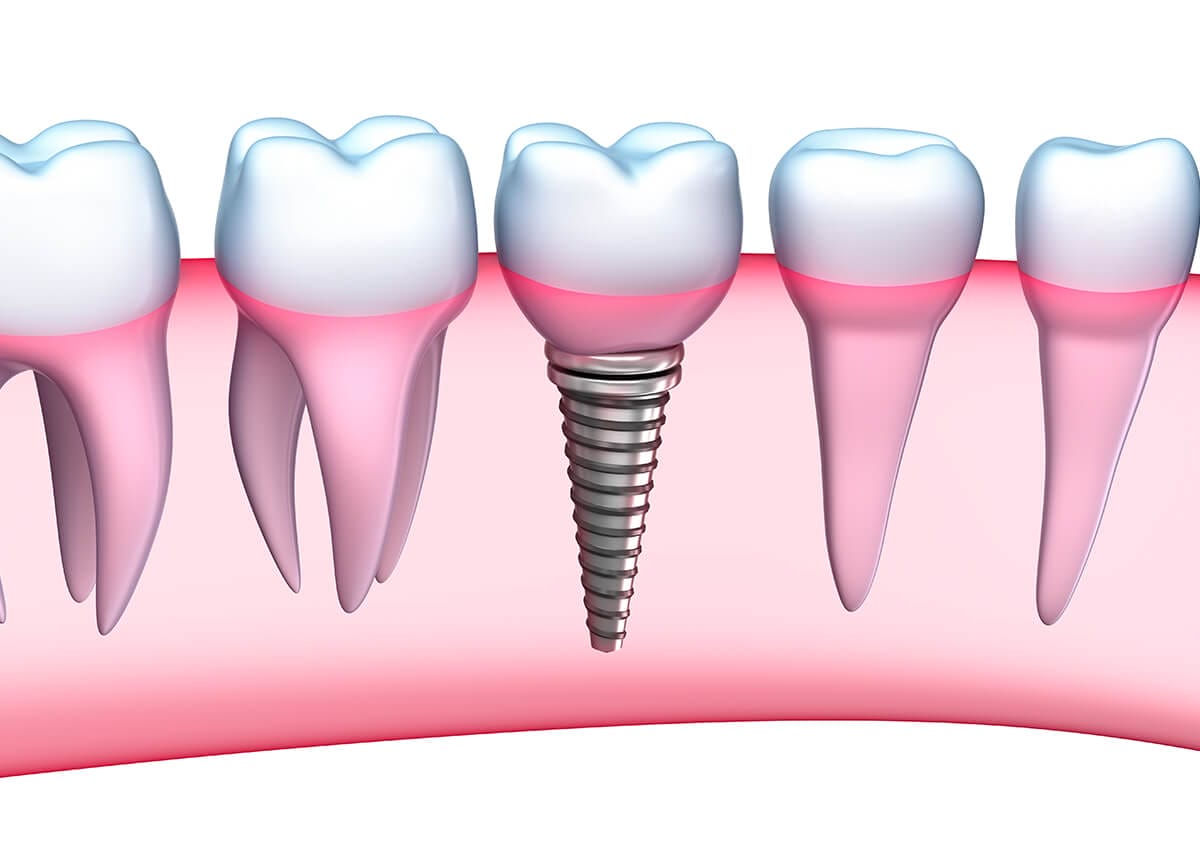 Missing Teeth Implants in Manakin-sabot VA Area