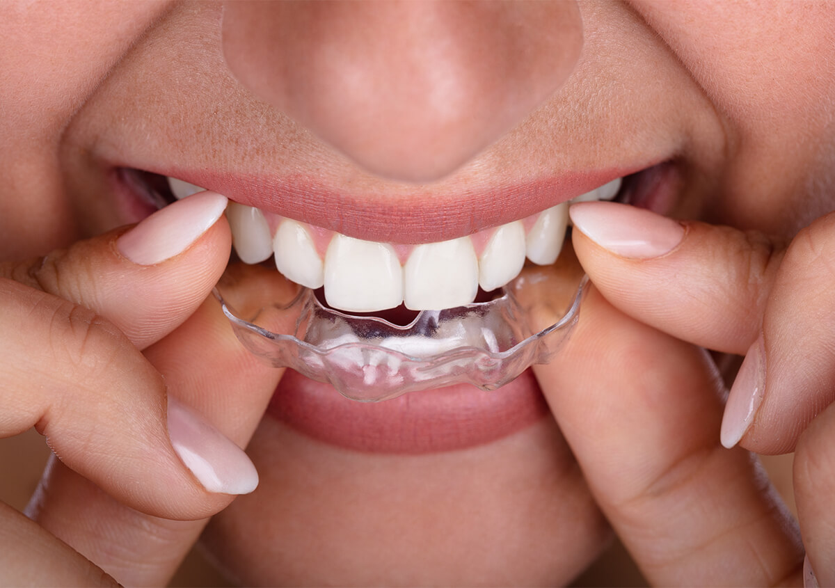 Dental Invisalign in Manakin-sabot VA Area