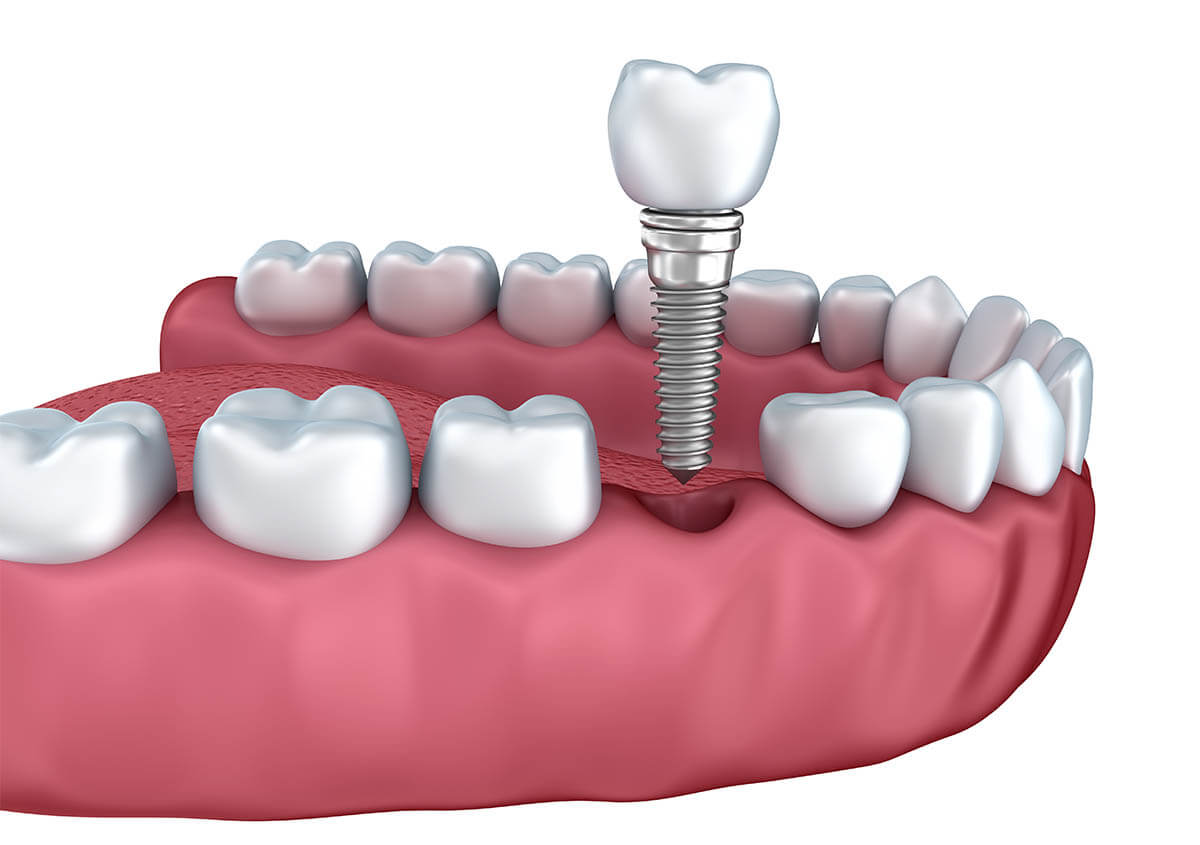 Dental Implants Procedure in Manakin-sabot VA Area