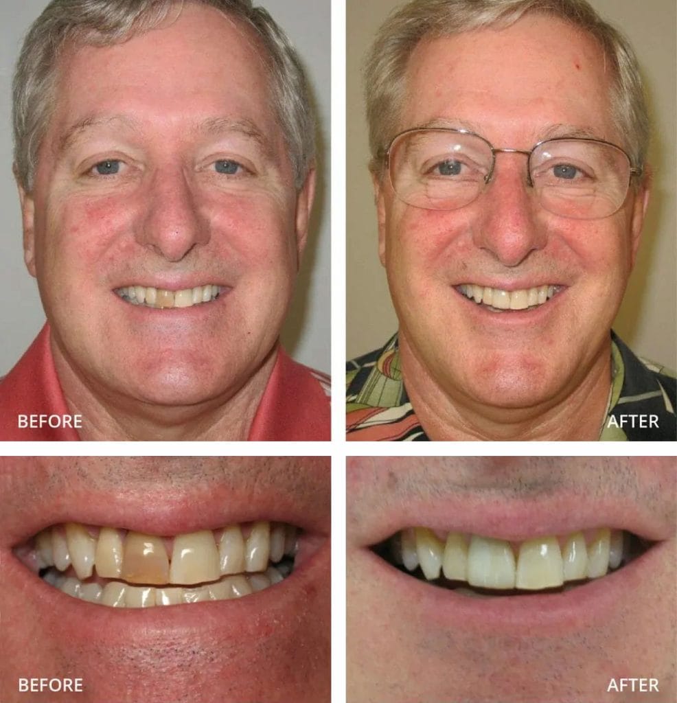 Before after images for Porcelain Crowns