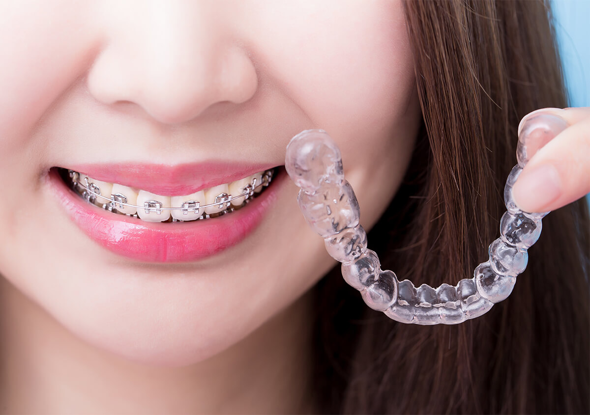 Is Invisalign Faster Than Braces in Manakin-sabot VA Area