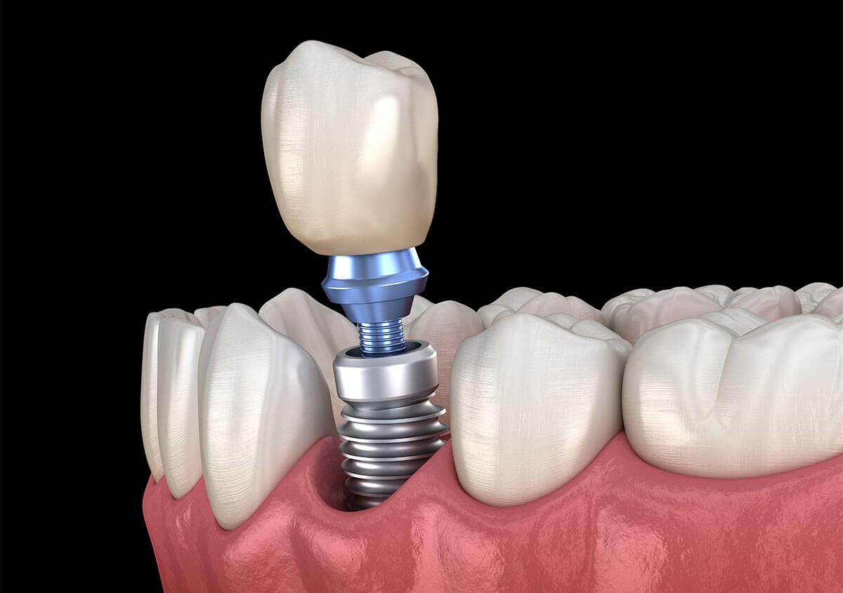 Which Type of Dental Implants Are Best in Manakin-sabot Area