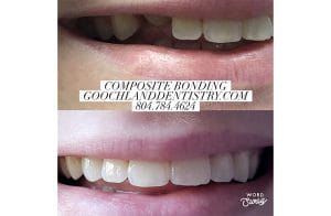 Composite Bonding before after treatment results - case 3