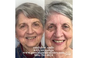 Invisalign before after treatment results - case 1