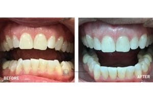 Invisalign before after treatment results - case 2