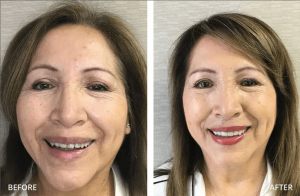 Smile Makeover
