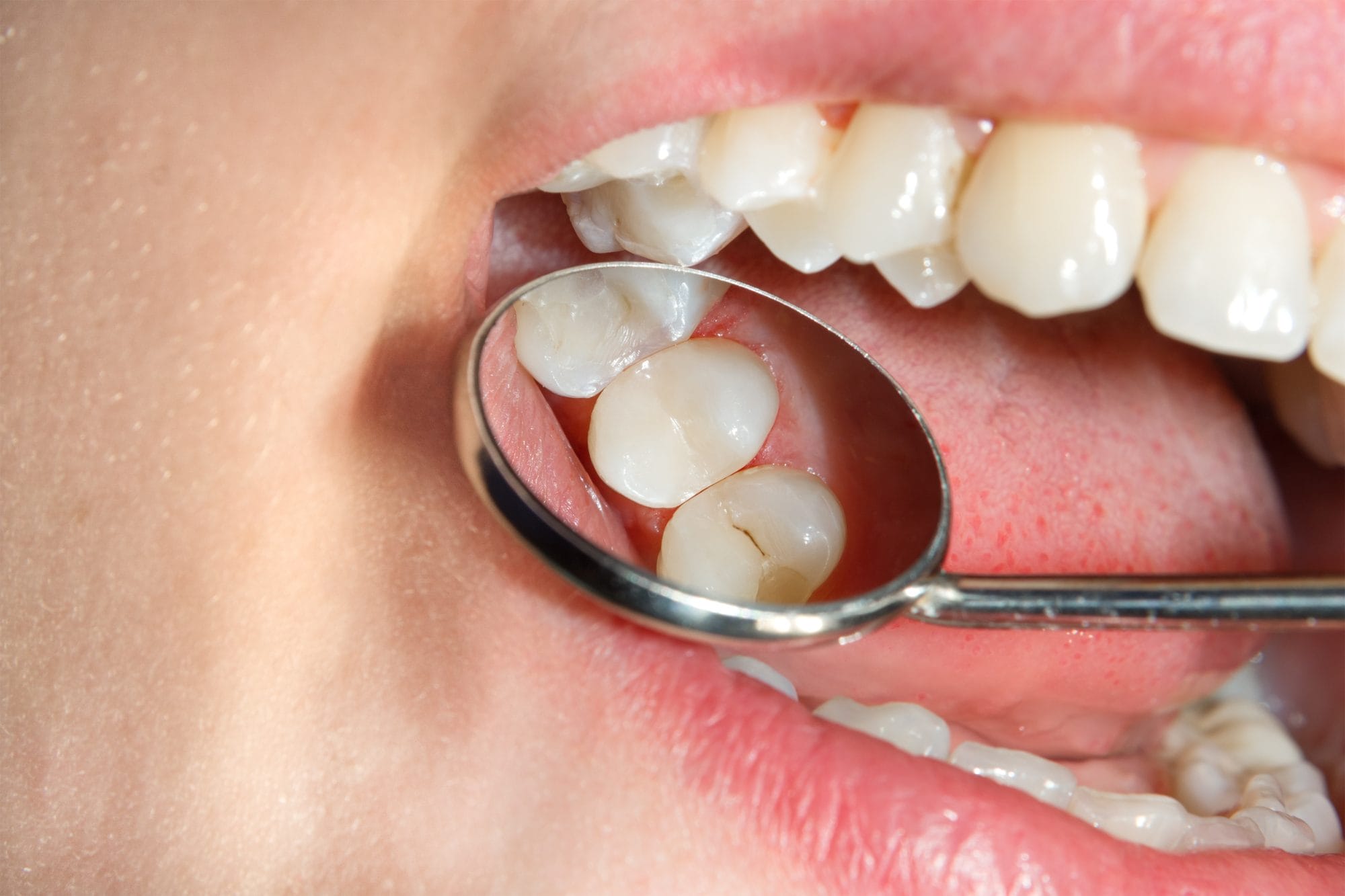 The Benefits of Dental Sealants for Adults and Teens
