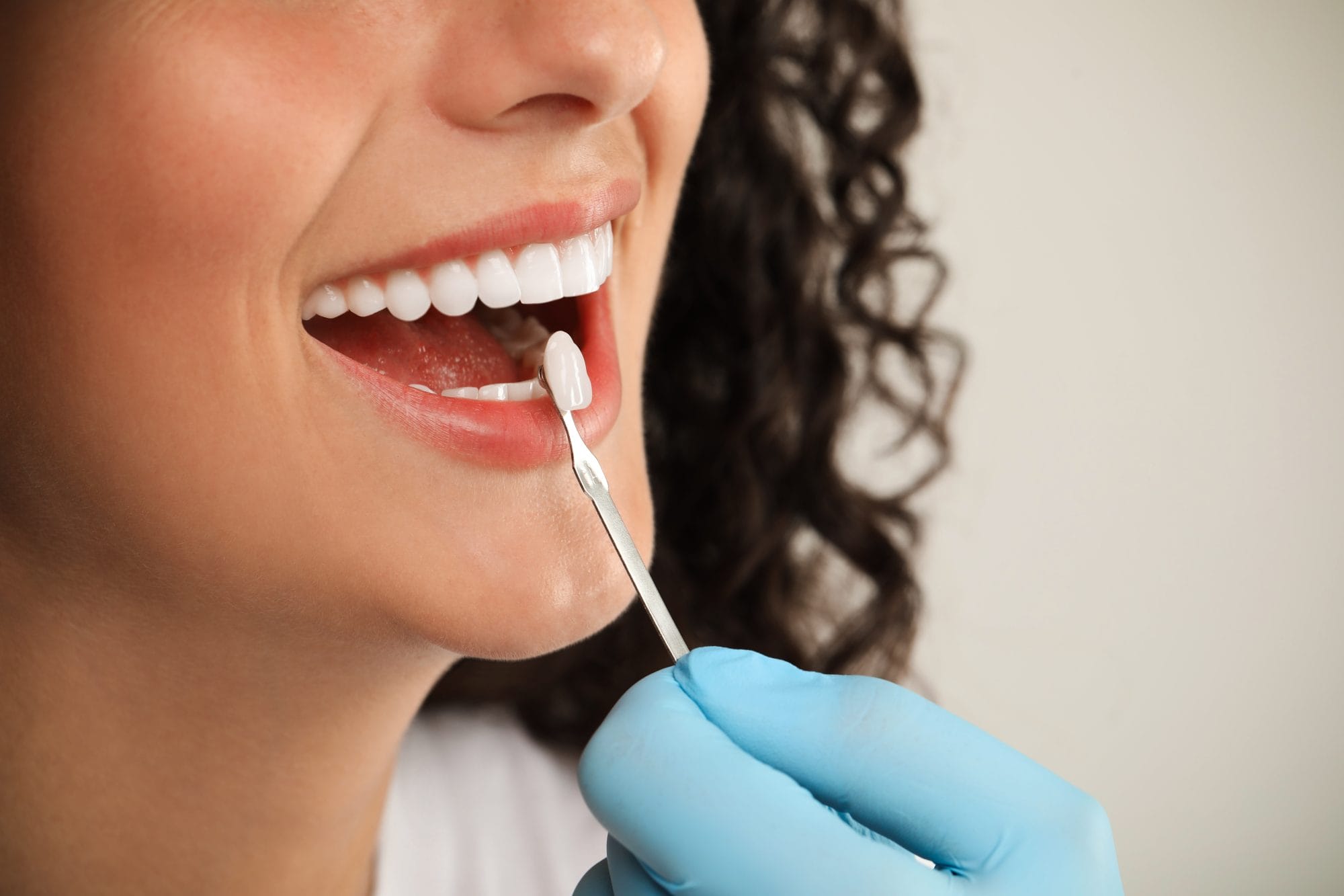 The Benefits of Dental Crowns for Restoring Damaged Teeth