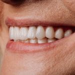 New Year Smile Guide: Teeth Whitening and Stain Prevention